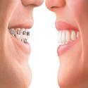  Tips memulai pemasangan ortho 